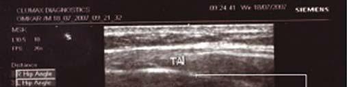Then the uddiyana bandha was performed and while holding the posture ultrasound image of TA was captured.