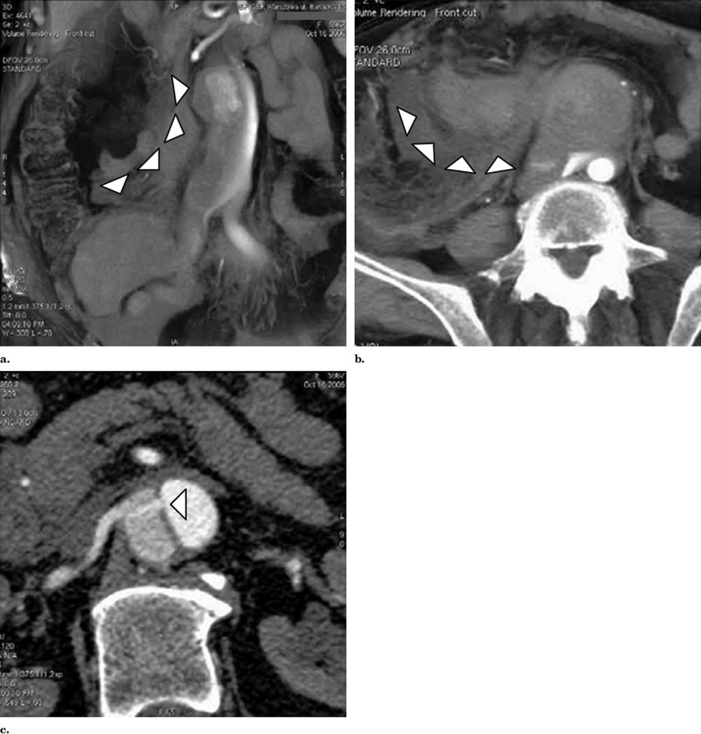 808 Endovascular Treatment for Ruptured Type B Aortic Dissection June 2009 JVIR Figure 1. (a,b) MRI images show a ruptured false lumen of the infrarenal aorta with retroperitoneal hematoma.