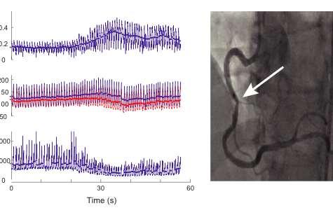 FFR Minimizing IC resistance during measurement of FFR Calculated during hyperemia