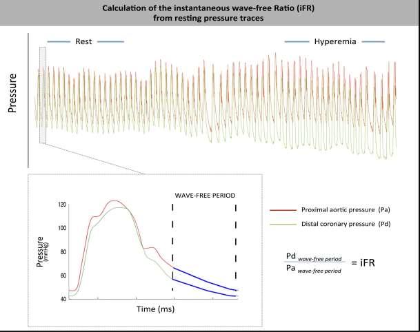 ifr Instantaneous pressure ratio across a stenosis during the wave-free period, when resistance is naturally constant and