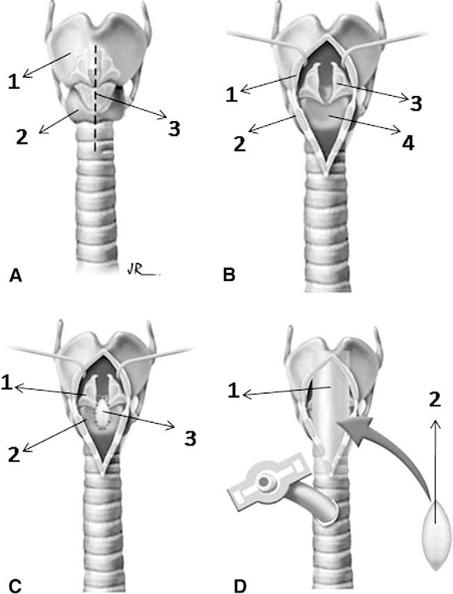 Terra et al General Thoracic Surgery Abbreviations and Acronyms CT ¼ computed tomographic CTR ¼ cricotracheal resection LTS ¼ laryngotracheal stenosis with no costal cartilage graft placement).