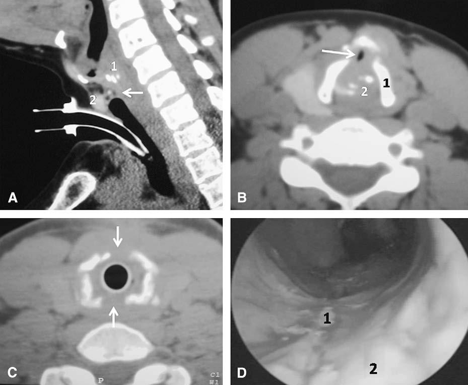 Terra et al General Thoracic Surgery FIGURE 3. A, Saggital cervical computed tomographic scan showing glottic/subglottic stenosis (arrow): 1, arytenoid cartilage; 2, anterior cricoid arch.