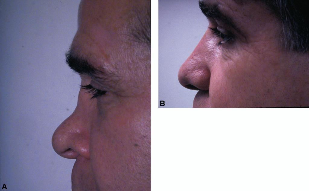 Moshaver and Gantous The use of autogenous costal cartilage graft... 863 Figure 1 (A) Pre- and (B) postoperative photographs of a patient with saddle nose deformity following nasal trauma.