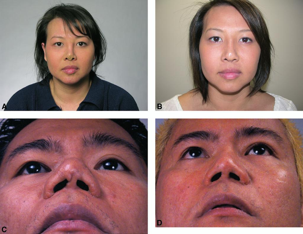 864 Otolaryngology Head and Neck Surgery, Vol 137, No 6, December 2007 Figure 2 Preoperative (A and C) and postoperative (B and D) photographs of patients with extruded silicone implant.