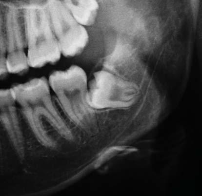 Comparison of panoramic radiography with cone beam CT in predicting the relationship of the mandibular third molar roots to the alveolar canal mic and CBCT images of 96 patients