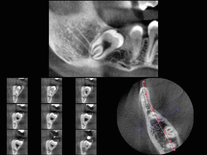 B Fig. 1. A. Cropped panoramic radiograph shows the interruption of the superior wall of the mandibular canal due to the root of the left impacted mandibular third molar. B.