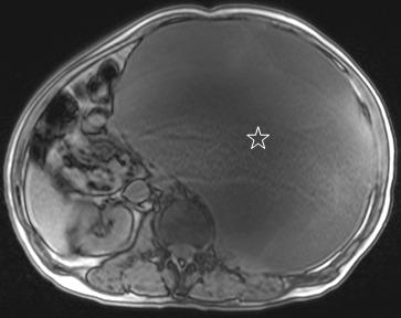 b. Axial T1-weighted fat-saturated MR imaging showed no prominent signal loss in this mass lesion.