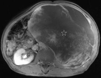 There was marked signal loss in the center of this image probably due to standing wave artifact. On dynamic contrast-enhanced axial T1-weighted fat-saturated MR imagings obtained in the d.