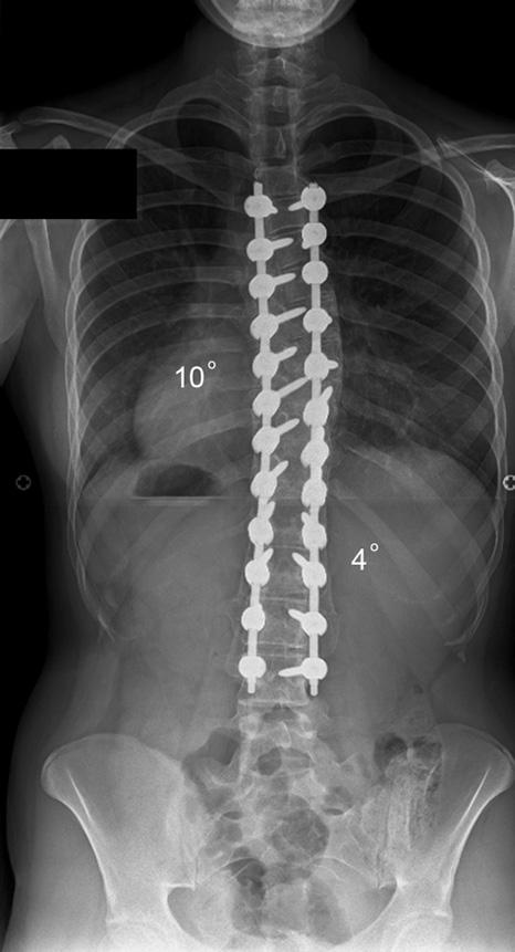 1d Pre-operative a) posteroanterior and b) lateral radiographs of the spine in a patient aged 12.