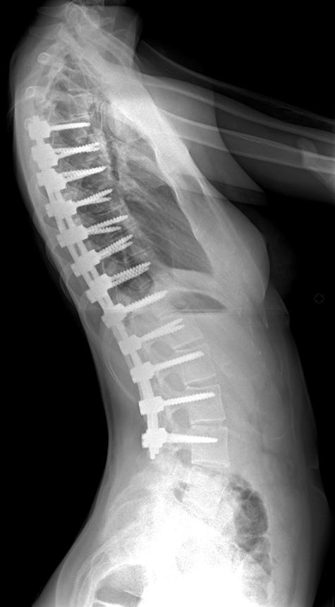 Post-operative c) posteroanterior and d) lateral radiographs at three years after posterior spinal arthrodesis using a bilateral segmental pedicle screw technique, showing satisfactory correction of