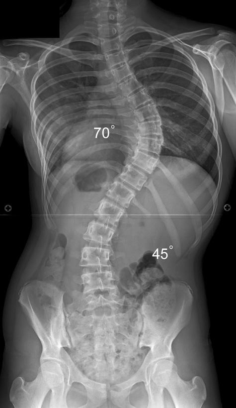 POSTERIOR SPINAL ARTHRODESIS FOR ADOLESCENT IDIOPATHIC SCOLIOSIS USING PEDICLE SCREW INSTRUMENTATION 1675 Fig. 2a Fig. 2b Fig. 2c Fig.