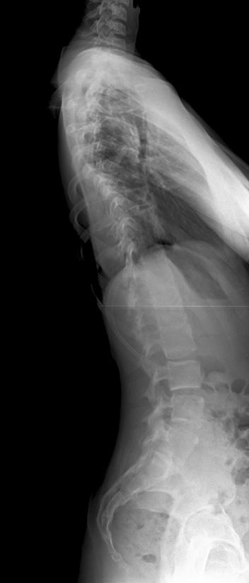 Post-operative c) posteroanterior and d) lateral radiographs at 3.