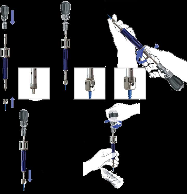 SPINE SYSTEM RESPONSE Pedicle Screw Driver Application 1 Attach handle to Poly Driver, select screw for insertion. 2 Place the hexalobe tip of the driver into the screw.