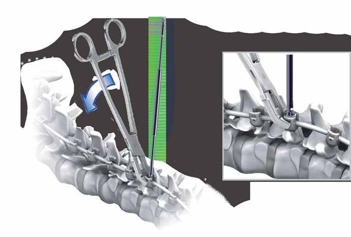 SPINE SYSTEM RESPONSE Rod Reduction Rocker Method Use of the Rocker is an effective method for reducing (or seating) the rod into the implant when only a slight height difference