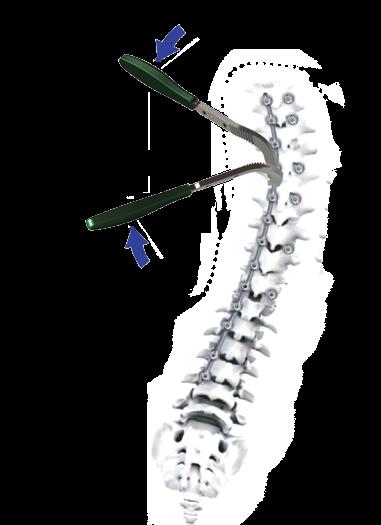 SPINE SYSTEM RESPONSE Deformity Correction Straighten Rod via Rotation and/or Coronal Bending Keep the set screws loose (or only locked at one end), then slowly straighten the concave rod with the