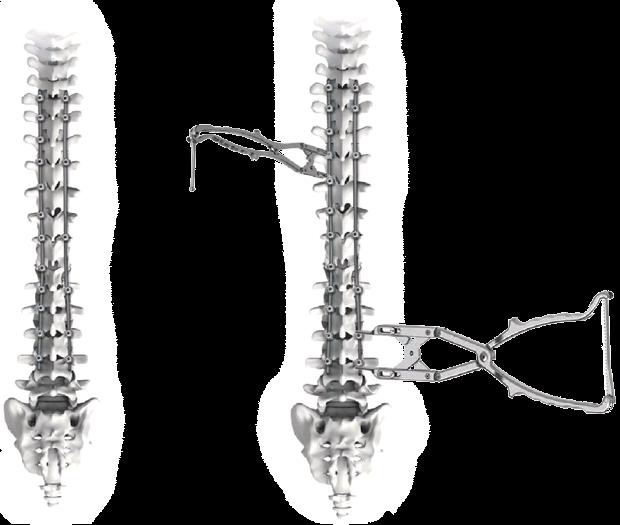 SPINE SYSTEM RESPONSE Deformity Correction Place the Stabilizing Rod Following placement of the second rod and set screws, convex compressive forces are placed on the segments using the Parallel