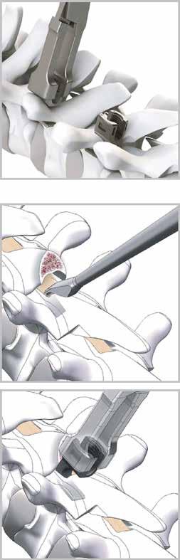 SPINE SYSTEM RESPONSE Hook Placement Hook Placement at the Transverse Process A Wide Blade Hook is typically used in a pedicle transverse claw construct as a caudal (down-going) hook.