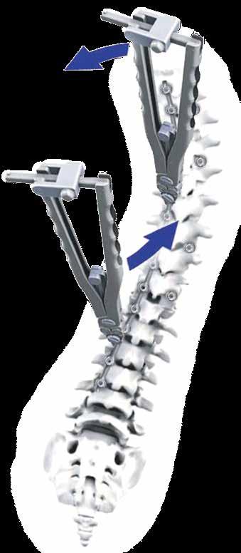SPINE SYSTEM RESPONSE Rod Rotation See pages 11-15 to reference rod reduction and contouring.