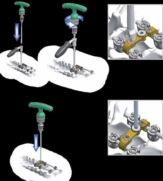 SPINE SYSTEM RESPONSE REVISION OR REMOVAL TECHNIQUE Cross-Connector Removal Place the X-Link Counter Torque Tube and the