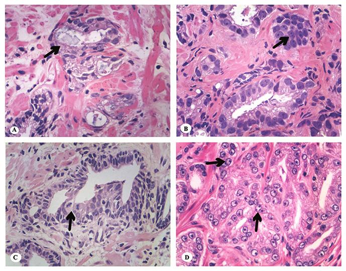 Frequency of the morphological criteria of prostate adenocarcinoma in 387 consecutive prostate needle biopsies: emphasis on the location and number of nucleoli found in carcinomas (13%-48%) and
