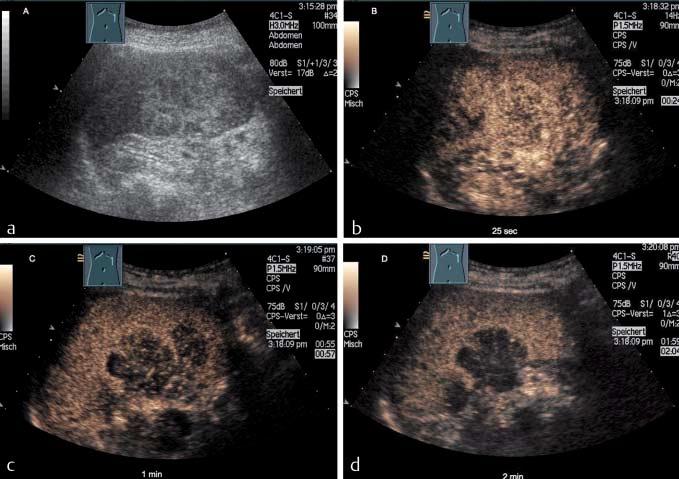 Original Article 267 Fig. 2 a Patient with ovarian cancer. On B-mode US a solitary focal hyperechoic lesion is seen. b Contrast-enhanced ultrasound (CEUS) demonstrates hyperechoic enhancement.