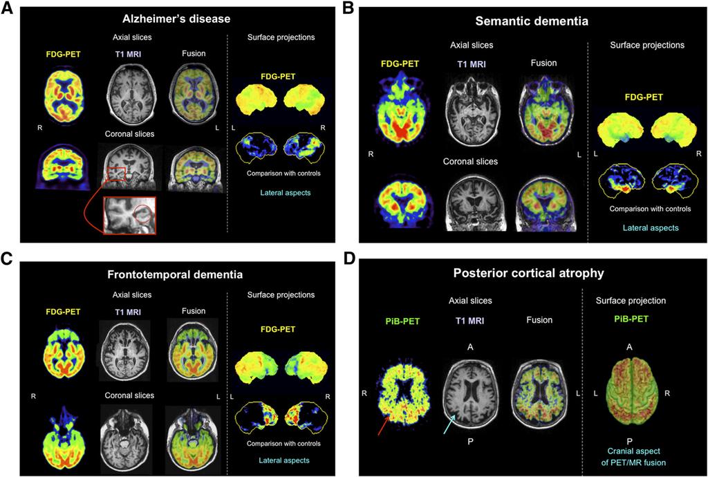 FIGURE 2. Multimodal differential diagnosis of dementia. (A) Typical patient with Alzheimer disease.