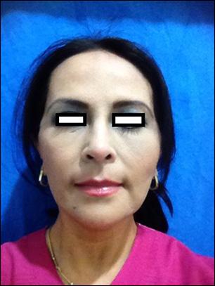 Facelift Features 1 s: Simple We elaborate the subcutaneous dissection with progressive tunneling.