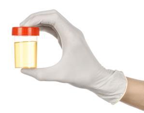 Two Types of Urine Drug Tests 1. Screening Immunoassay ( urine drug screen ) Detects drug class Opiate screen reliably detects morphine and codeine only Does NOT detect synthetic opioids (e.g., fentanyl, meperidine) Above a threshold concentration 2.