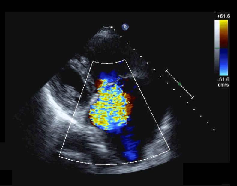 Echocardiography: TR Jet Velocity TR jet velocity = RV pressure RAP Doppler TR Jet Velocity RVSP 4(TR jet velocity) 2 + RAP RAP estimated from RA size IVC size IVC inspiratory collapse Multicolored