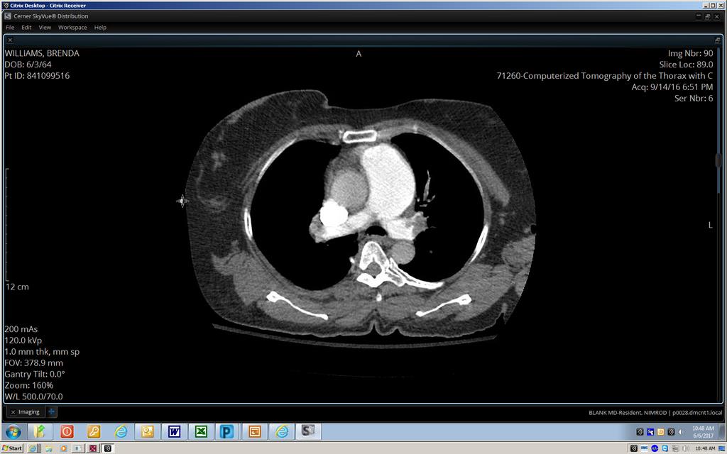 Computed Tomography Sub massive pulmonary embolism: the main right