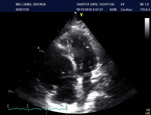 Echocardiography Before Impella: