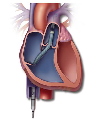 Impella RP Indicated for providing circulatory assistance for