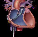 Impella RP Tandem Heart V-V ECMO (CentriMag) Mechanism Micro-axial Centrifugal