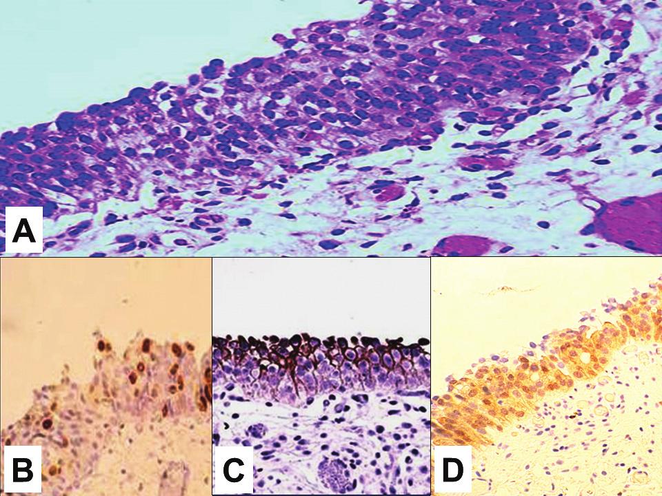 Volume 37, Number 0/Month 2015 Dysplasia and Carcinoma in Situ 3 LOW RESOLUTION NEED TO BE REDONE also, there is usually overexpression of p53, and high Ki-67 proliferation index.
