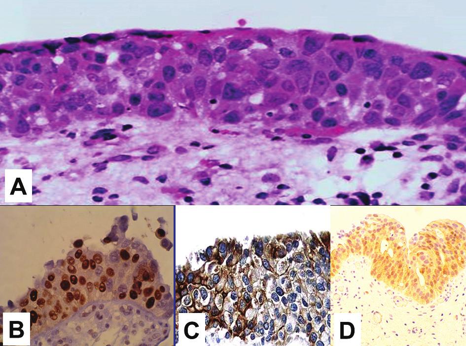 Volume 37, Number 0/Month 2015 Dysplasia and Carcinoma in Situ 7 LOW RESOLUTION NEED TO BE REDONE may be present, often extending to the upper layers of the urothelium.