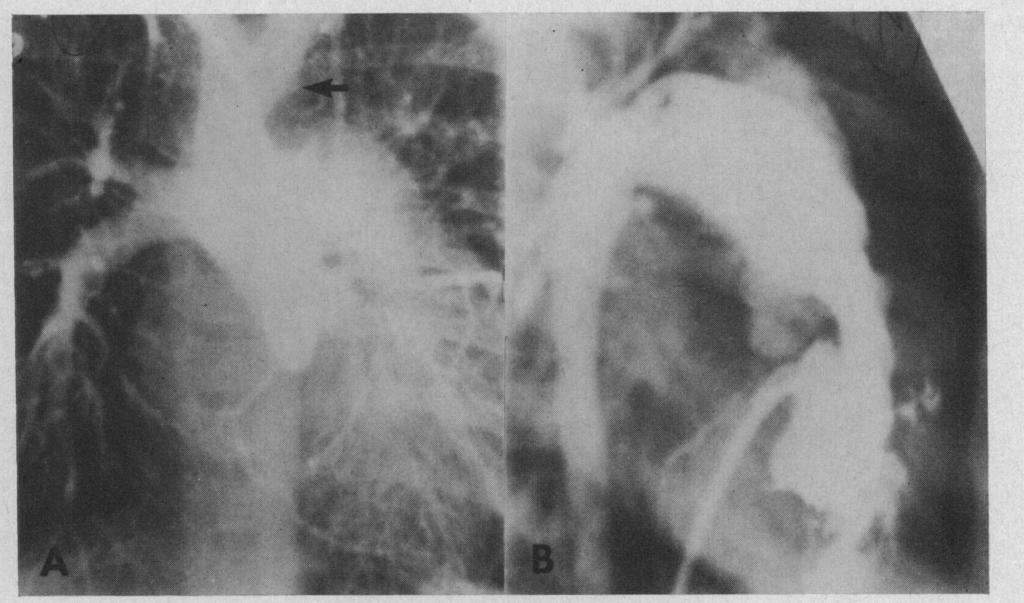 634 Blieden and Moller FIG. Angiograms in Case I5. Coexistent aorticopulmonary septal defect and interruption of aortic arch. A) Aortogram. Anteroposterior view.