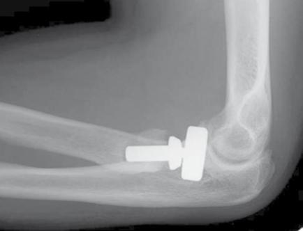 KATALYST Introduction Description The Katalyst Telescoping Bipolar Radial Head implant restores the support and bearing surface of the radial head in the face of fracture, arthritis or failed prior