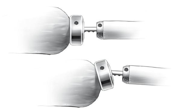 Step 10 Implant alignment Intraoperative radiographs may be used to confirm appropriate size and position of the implant. The stem should be aligned with the longitudinal axis of the radius.