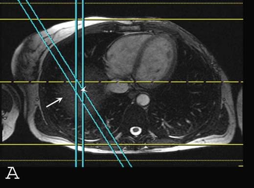 Navigator echo and imaging volume in 3D SSFP MRA Axial Scout Two intersecting slices are placed over the diaphragm