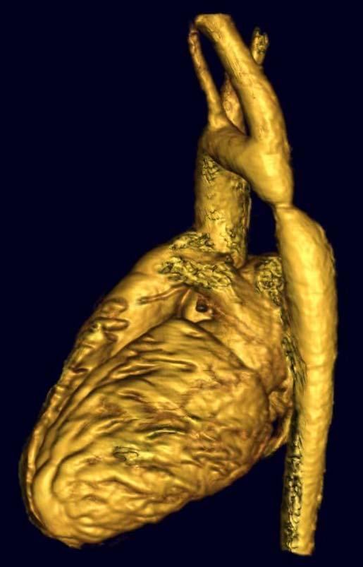 the ascending aorta ( B).