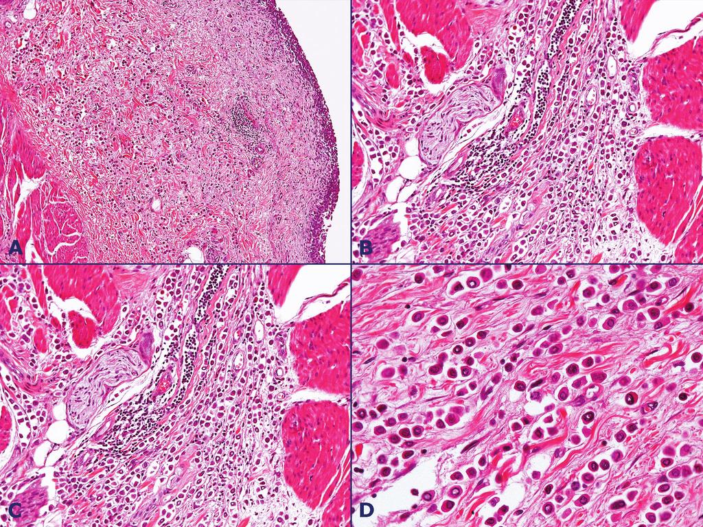 Plasmacytoid urothelial carcinoma: a case of histological variant of urinary bladder cancer with aggressive behavior After 8 months, the patient presented progressive swelling and pain in the