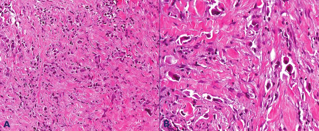 Plasmacytoid urothelial carcinoma: a case of histological variant of urinary bladder cancer with aggressive behavior Figure 5.