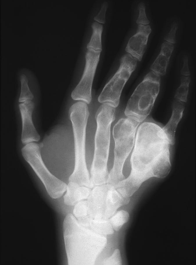 Bulletin of the NYU Hospital for Joint Diseases 2012;70(4):235-40 237 lesions as well as metastasis. Bone Producing Incidental Lesions Enostoses are also known as bone islands.
