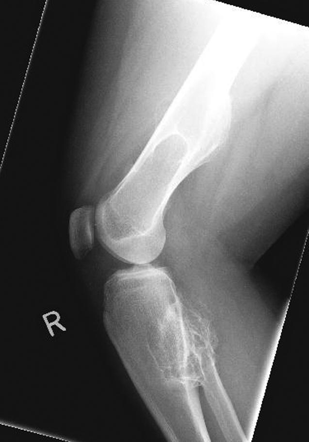 This benign lesion is usually asymptomatic and can be associated with a pathologic fracture. These lesions are seen in children and adolescents. They can regress or ossify with skeletal maturity.