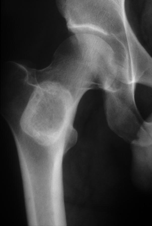 B, Lateral radiograph of the right leg of the same patient, demonstrating a large pendunculated lesion of the proximal fibula and sessile lesions of the distal tibia. B diaphyseal with growth.