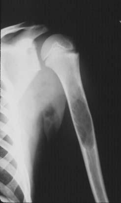 Unicameral (Simple) bone cyst: Most common in the proximal humerus, these are always central, full width lesions which may cause cortical thinning and minimal expansion but usually have no associated