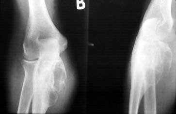 Figure 15 Aneurysmal bone cyst: As the name implies, these lesions are usually very expansile or aneurysmal (Figure 16).