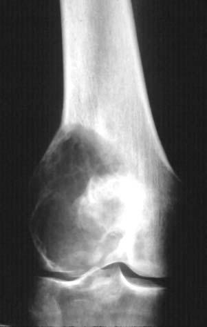Giant cell tumor: This appears as a juxta-articular lytic lesion frequently with cortical thinning and expansion, possible soft tissue extension but usually no periosteal reaction (Figure19).