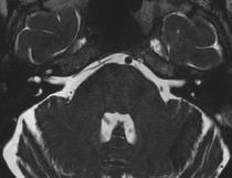 5mm Neurovascular compression MRA of the head