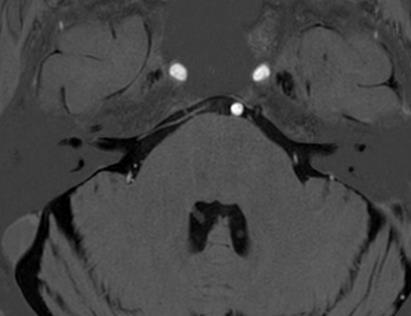 flow Imaging of intracranial veins Slow flow Sinus